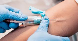 FLEBOTOMIA & PLASMA RICO EN PLAQUTAS + RICO EN FIBRINA